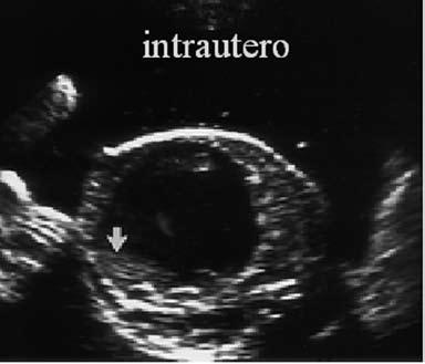 9-10 a b c Fig 4_Ecografía A) Visualización de glándula Suprarenal de aspecto cerebroide y aumentada de tamaño B) útero presente: Imágen compuesta que muestra vejiga con vagina y útero ligeramente
