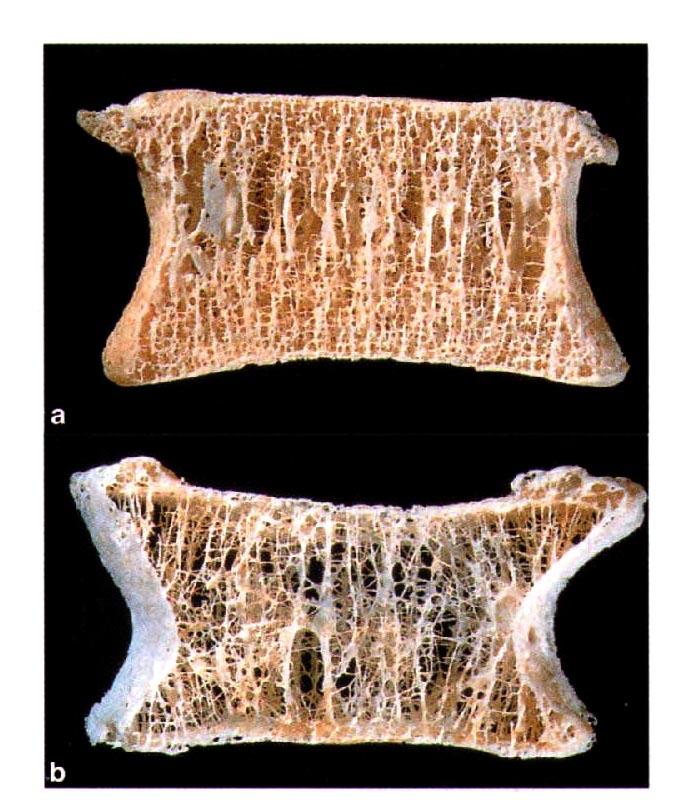 TEJIDO ÓSEO: Anatomía macroscópica Disco intervertebral Tejido óseo trabecular (esponjoso) Tejido óseo cortical (compacto) Tejido óseo trabecular o esponjoso: finos listones/hojas (=trabéculas) que