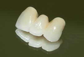 diente que falta, y el protésico elabora dos coronas en los dientes pilares, unidos a la pieza protésica que ocupara el espacio