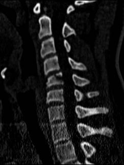 Técnicas de imagen Radiografía TC: Contribuye a detección de fracturas