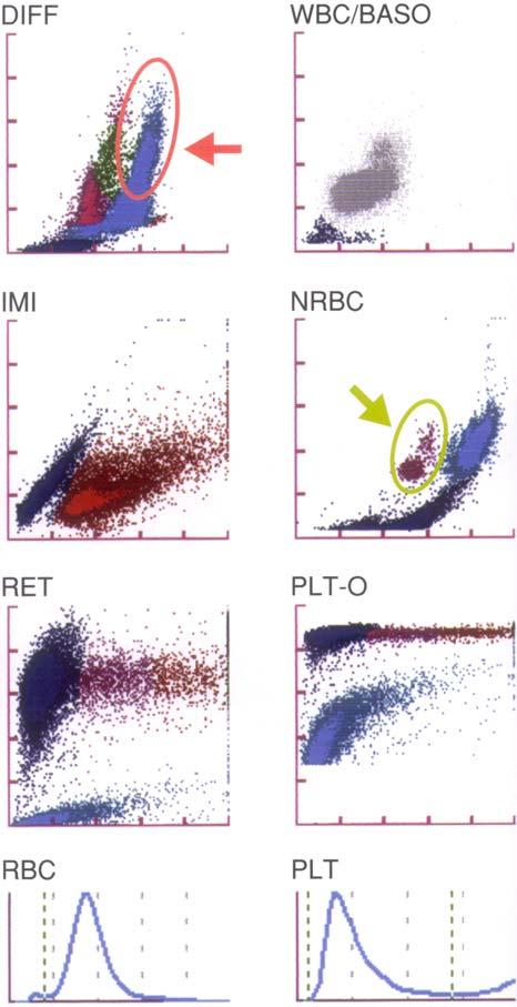Casos de células inmaduras de tipo mieloide Mielofibrosis Información del XE-2100 Información medida por el XE-2100 * WBC & 47.03 *[10 9 /L] RBC 3.02 [10 12 /L] HGB 84 [g/l] HCT 27.3 [%] MCV 90.