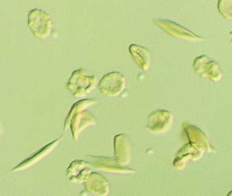 Información obtenida del análisis del frotis Fotografía de microscopía electrónica Este es un caso de enfermedad de células falciformes.