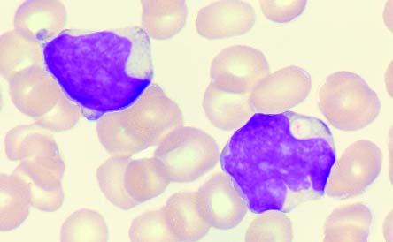 2 x 10 9 /L (linfoma atípico 23%), LDH 691 IU/L y sil 2R 3.625 U/L. El análisis del frotis de sangre periférica mostró que este caso era un linfoma blástico de linfocitos tipo NK.
