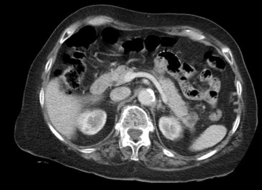 Fig. 4: Proyección axial de TC abdominal con CIV en paciente con pancreatitis aguda necrotizante, donde se