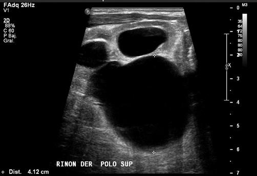 03 cm, corteza renal adelgazada y alteración de la vascularidad por dilatación pielocalicial; no se observó el uréter; y el riñón izquierdo y la vejiga no tuvieron alteraciones (figura 3).
