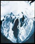 Fenotipo clásico DEPÓSITO VASCULAR DE GL-3 3 Piel Nervios periféricos Corazón Cerebro Riñón