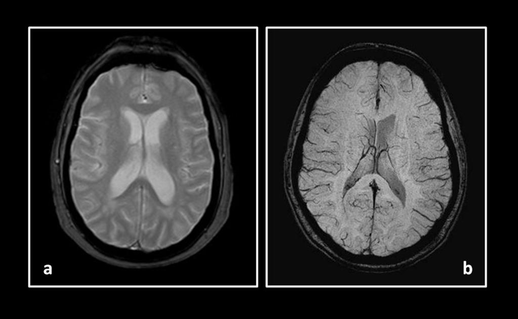 Fig. 3: RM cerebral normal.