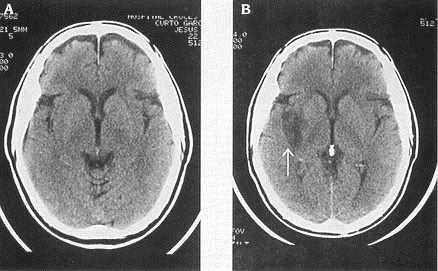 TAC cerebro sin contraste Rápido y no invasivo Pesquisa hemorragias intracraneanas (S/E sobre 98%) Signos precoces