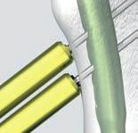 El medidor de profundidad indica directamente la longitud adecuada para el tornillo de cadera. Retire el medidor de profundidad y la aguja guía caudal.