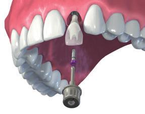 4.1.6 Inserción (clínica dental) Pilares Straumann CARES Procedimiento prostodóncico Preparación Retire el pilar de cicatrización o la restauración provisional.