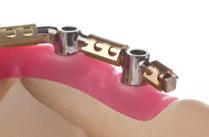 4.3.2 Barras CARES Uso previsto Las barras Straumann CARES para prótesis fijas son superestructuras de aplicación directa con resina dental y dientes acrílicos prefabricados para tratar casos de