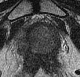 a b c d Neoplasia de próstata con