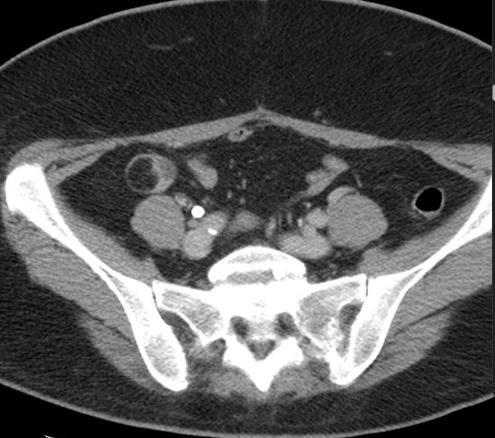 Clasificación TUMORES MALIGNOS Adenocarcinoma Linfoma intestinal Tumor carcinoide Tumor del estroma gastrointestinal (GIST)