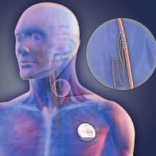 Cómo funciona VNS Therapy VNS significa estimulación del nervio vago El nervio vago es una de las principales vías de comunicación entre los principales órganos del cuerpo y el cerebro Nervio vago