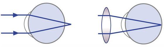 Las gafas de lentes convergentes corrigen este problema proporcionando la potencia adicional de enfoque necesaria. Figura 15.3.2.