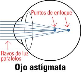 Las personas con astigmatismo no pueden enfocar simultáneamente las líneas verticales y las horizontales.