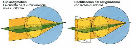 Figura 15.3.4.2. Corrección de astigmatismo lateral. 15.3.5.- Cuadro resumen de ametropías.