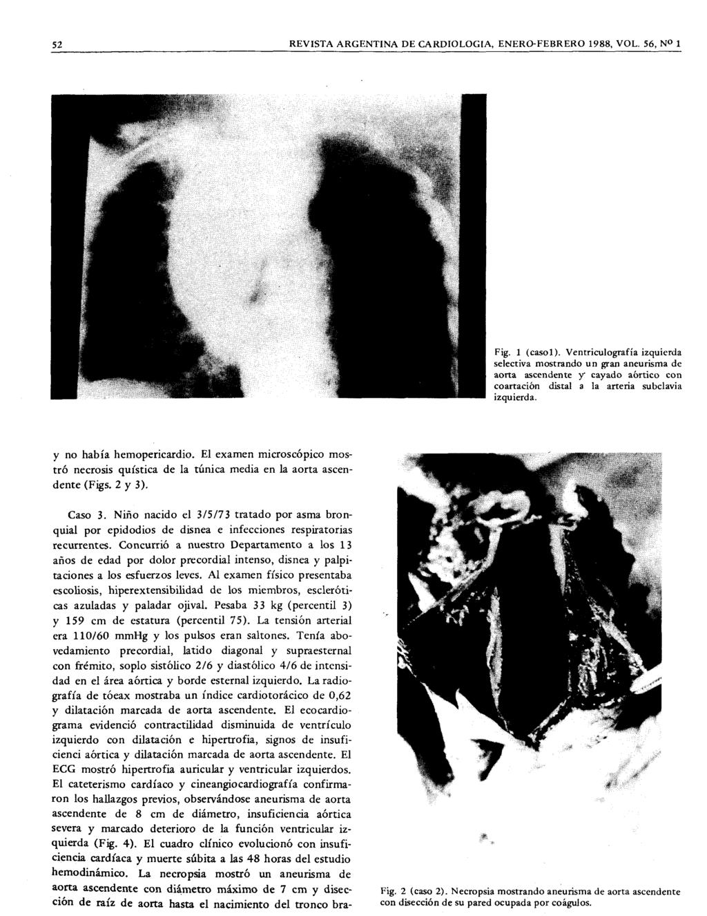 52 REVISTA ARGENTINA DE CARDIOLOGIA, ENERO-FEBRERO 1988, VOL 56, NO 1 Fig 1 (csol) VentricuIogrfí izquierd selectiv mostrndo un grn neurism de ort scendente Y' cydo órtico con cortción distl l rteri