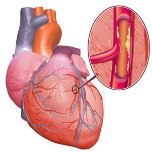 Enfermedades cardiovasculares: Salud cardiovascular: Arterioesclerosis: endurecimiento de las arterias debido al depósito de grasa y colesterol en sus paredes.