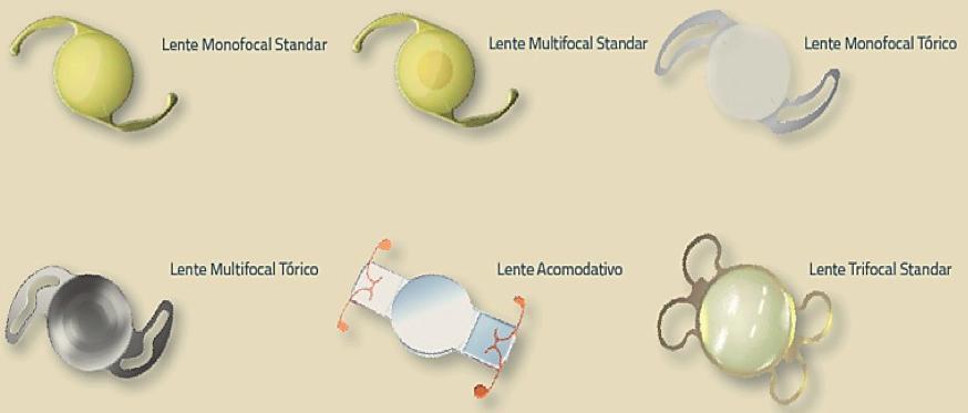 Ilustración 5. Tipos de lentes posibles a implantar en la cirugía de la catarata.