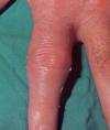 GOTA: Litiasis úrica Artritis aguda Tofos