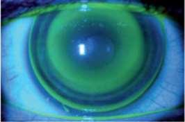 Figura 7. Fluorograma en patrón de ojo de buey. Fuente: (Juan & Piñero, 2010).