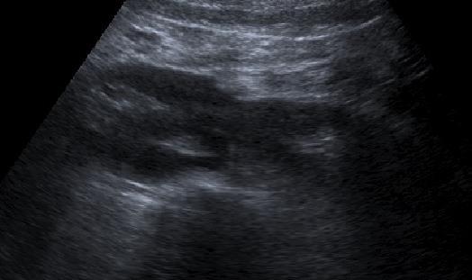 Riñón en Herradura Pseudotumor renal del desarrollo Hipertrofia columna de Bertin El riñón en
