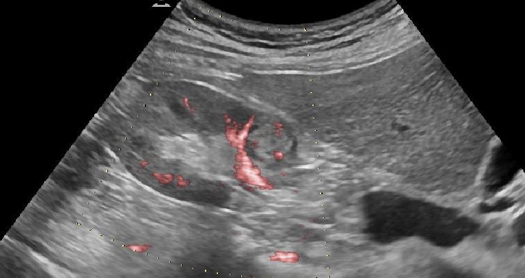 el contorno renal, con vascularización parcheada en su interior en el
