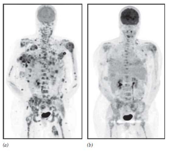 sustancia. Las regiones oscuras de la tomografía muestran la ubicación de las lesiones cancerosas con actividad metabólica.