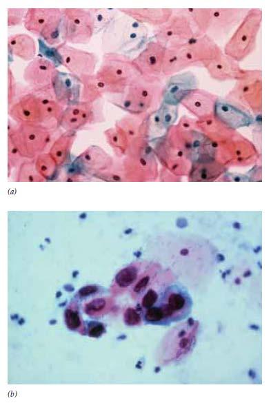 Figura 16.8 Detección de células anormales (premalignas) en un extendido de Papanicolaou. (a) Células epiteliales escamosas normales del cuello uterino.