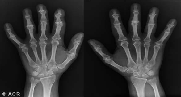 Hallazgos Radiológicos Artrosis Articulaciones sinoviales Formación de osteofitos Disminución del espacio articular Esclerosis del hueso subcondral Formación de quistes óseos Alteración en el