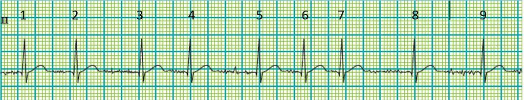 Finalmente contamos con otro método que se puede utilizar cuando el ritmo que encontramos en el EKG es Sinusal o No Sinusal.