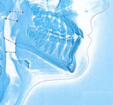 3.2.3.3. Espacio mandibular: Es el espacio anterior de la laringe 82. Sevalora: Distancia tiromentoniana (Fig. 3.