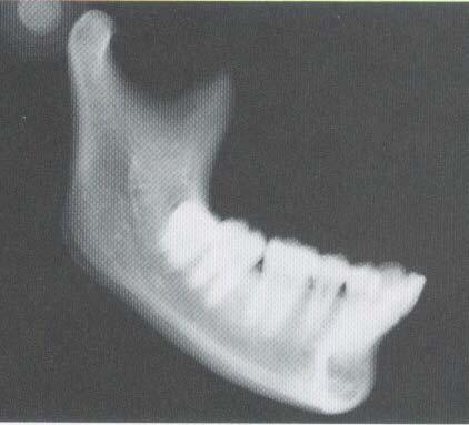 Borde posterior 8. Foramen mandibular 9. Foramen mentoniano 10.