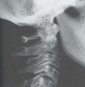 17 Vértebras Cervicales 149 7. Apófisis odontoides del axis 8.
