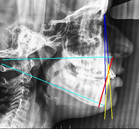 Mandibular : valora la inclinación de la mandíbula respecto a la base del cráneo mediante el Angulo Silla-Nasion.Plano Mandibular (Gonion Menton) 158. 3.