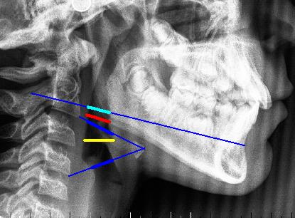 Distancia apw2-ppw2 : Mide la distancia desde la pared anterior a la pared posterior de la faringe sobre la línea desde el punto anteroinferior del cuerpo de la 2ª-vértebra cervical hasta el punto