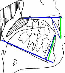 Md : angulo formado por el eje del incisivo inferior con el plano mandibular, valora la inclinacion del incisivo respecto de la mandibula 159. 4. Distancia II.
