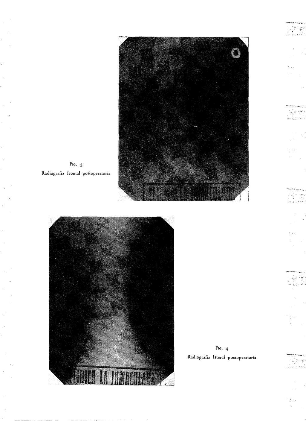 FIG. 3 Radiografía frontal posloperatoria,
