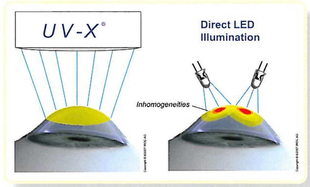 Equipo de emisión UV + fotoactivador. El sistema UV-X 2000 ha sido desarrollado por los Drs. Theo Seiler y Eberhard Spoerl.