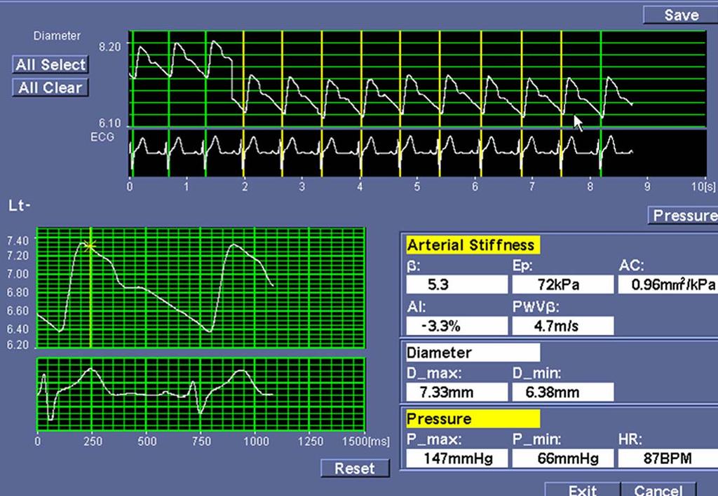 MATERIAL Y MÉTODOS AC β Ep AI PWVβ Compliance arterial Índice de rigidez Módulo elástico Índice de aumento Velocidad de la onda de pulso Exploración ecográfica (e-traking) Compliance arterial (AC):