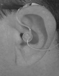 auricular dentro del canal auditivo. 2.