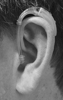 Inserción de la cápsula potente o del molde para oído 1.