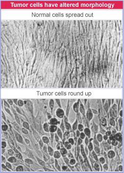 Etapas de la progresión tumoral Aparición de células primarias anormales