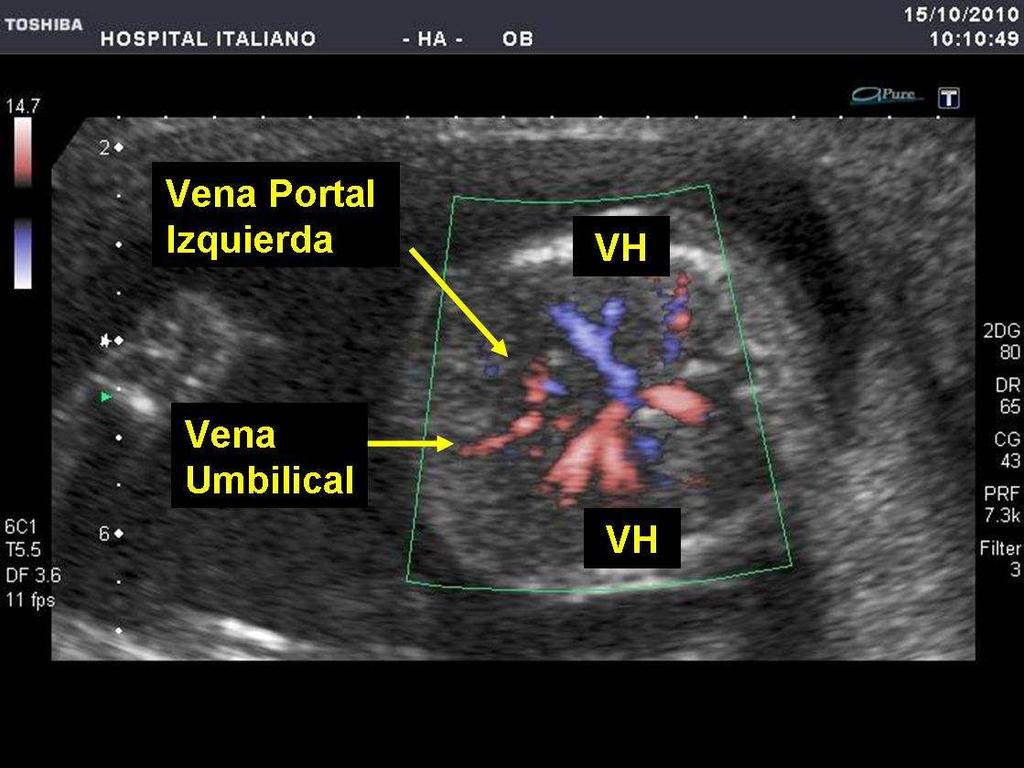 A las 18 semanas la ecografía mostró quistes de plexos coroideos, ventriculomegalia bilateral, CIV y regurgitación