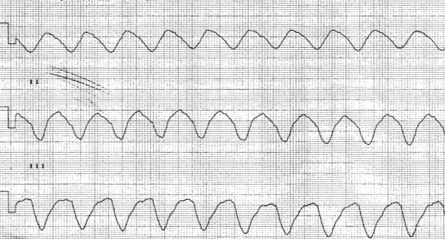 Imagen en sinusoide (ondas continuas regulares, amplias e iguales) Imposibilidad de reconocer el QRS ni la onda T Frecuencia >250lpm FIBRILACION VENTRICULAR