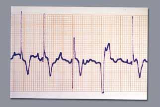 Arritmias Cardiacas 132 133 Extrasístole ventricular. Complejo prematuro ventricular (CV) El foco ectópico se localiza en el miocardio ventricular, en el haz de His o por debajo de él.