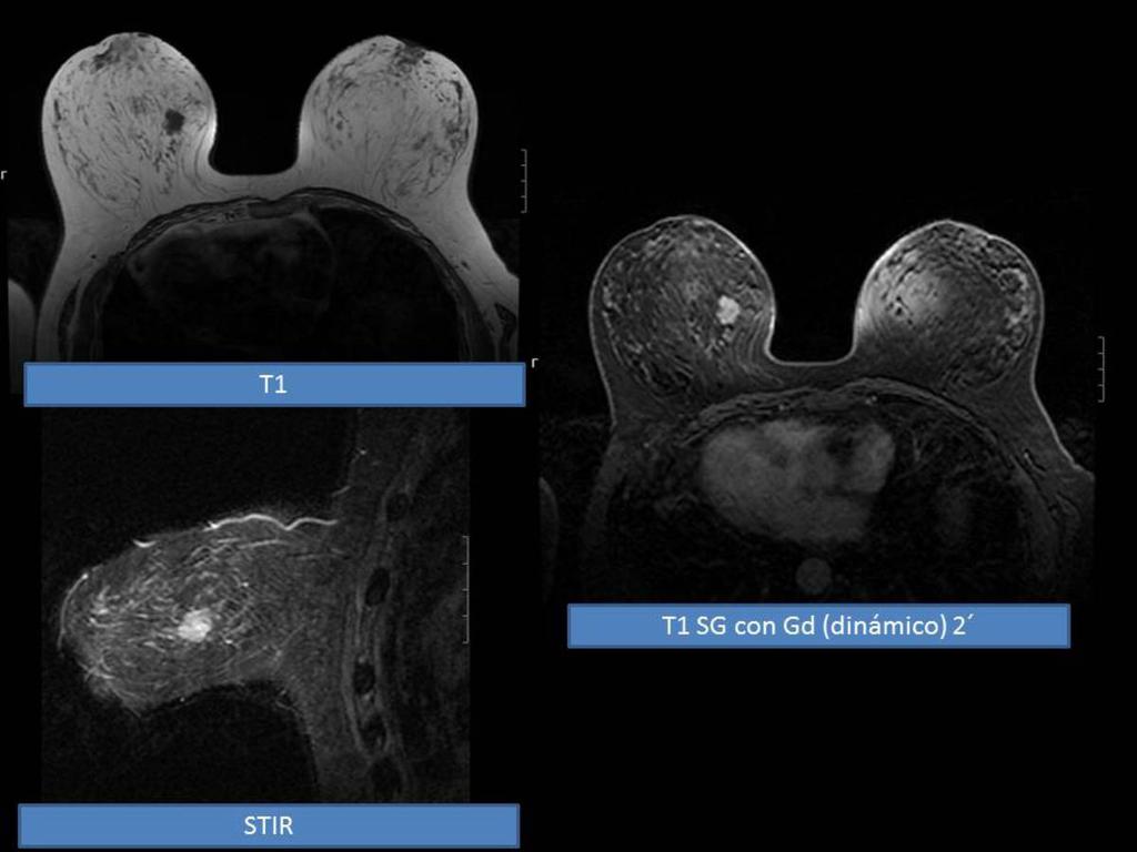 Fig. 18: Nódulo polilobulado, bien definido en CII mama izquierda, hipointenso en T1,