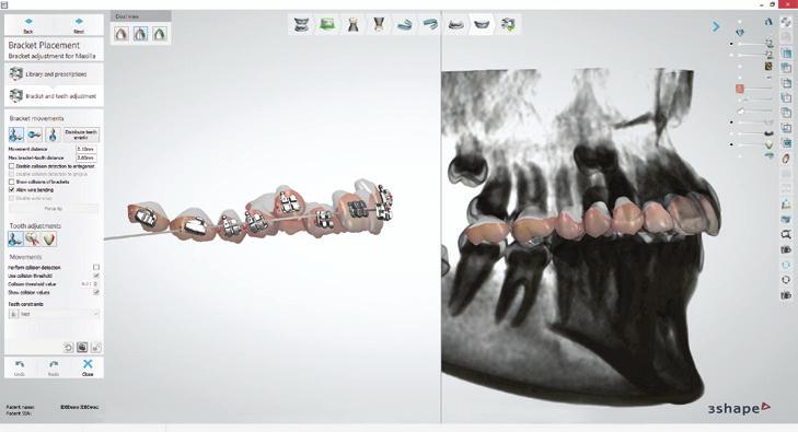 Ofreciendo más servicios a sus pacientes y socios Aproveche los flujos de trabajo digitales perfectamente integrados con los escaneos de 3Shape X1, implantes de 3Shape y software de ortodoncia.