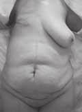 simultánea con la cirugía para el tratamiento del cáncer o mastectomía (11). El tejido más utilizado es la piel y grasa de la parte inferior del abdomen el cual es abundante en muchas mujeres maduras.